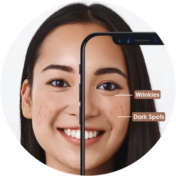Wrinkles and Dark Spots Skin issues of a girl are identified using AI skin analysis